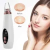 Electric Blackhead Remover Vacuum